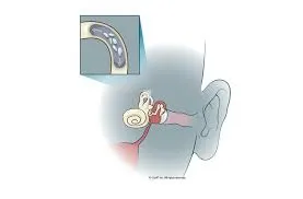Ilustracija notranjega ušesa pri BPPV