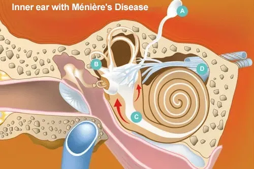 Ilustracija notranjega ušesa pri Ménièrovi bolezni