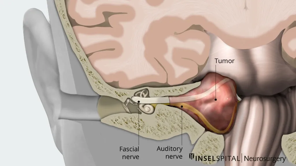 Anatomska ilustracija švanoma slušno-ravnotežnega živca